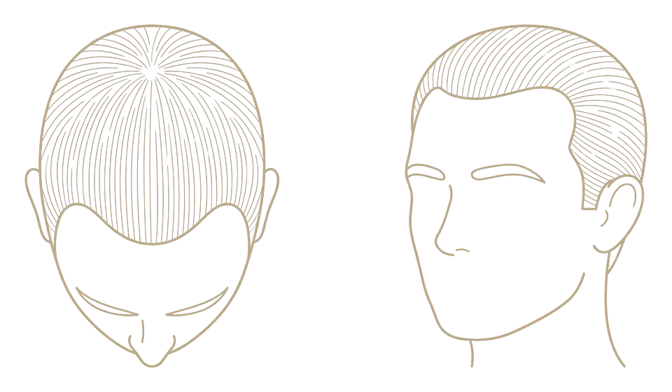 Norwood stage I — no visible loss: schematic line drawing of the scalp from above and in three-quarter view