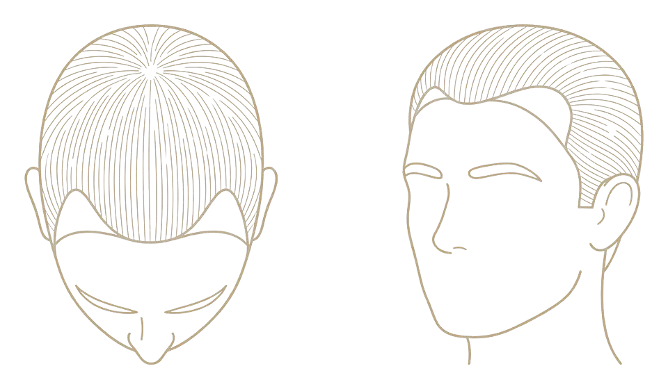 Norwood stage II — mature hairline: schematic line drawing of the scalp from above and in three-quarter view