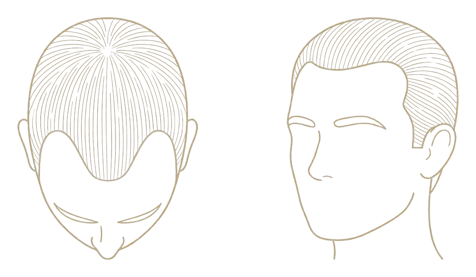 Norwood stage III — first real recession: schematic line drawing of the scalp from above and in three-quarter view