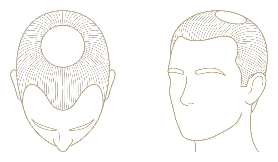 Norwood stage IV — recession and crown: schematic line drawing of the scalp from above and in three-quarter view