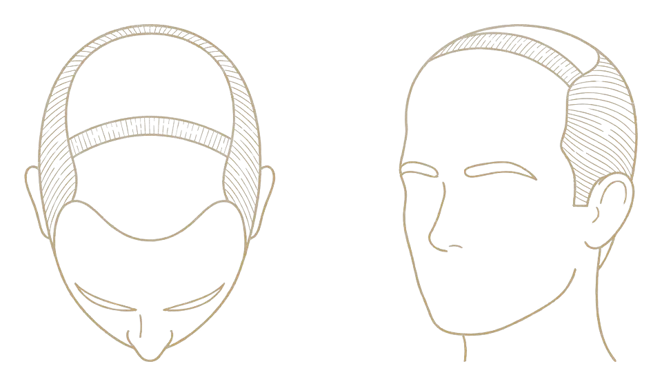 Norwood stage V — the band narrows: schematic line drawing of the scalp from above and in three-quarter view