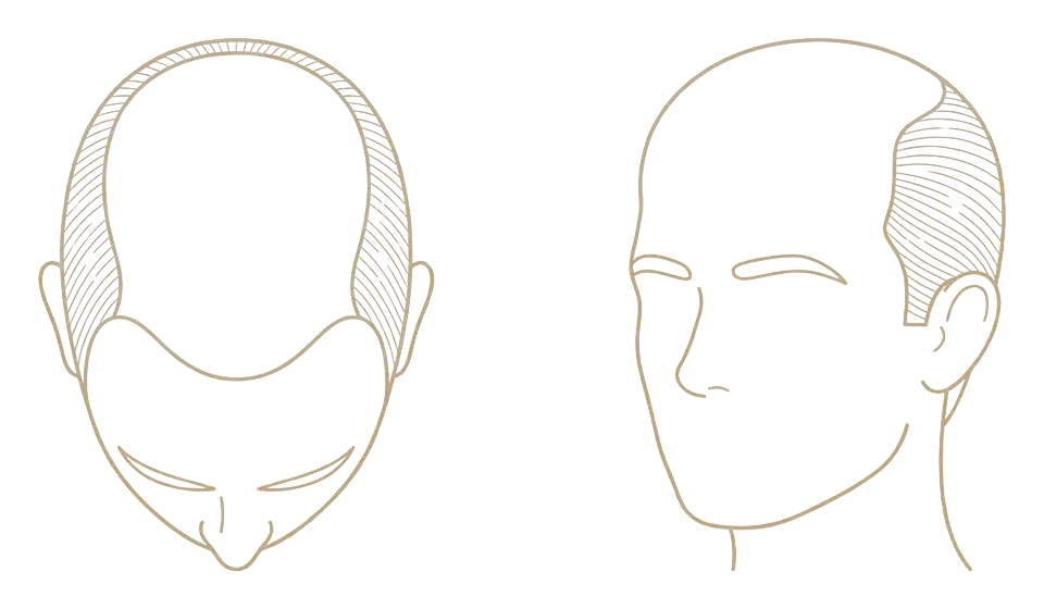 Norwood stage VI — front and crown join: schematic line drawing of the scalp from above and in three-quarter view