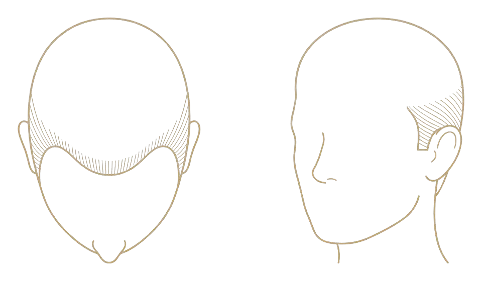 Norwood stage VII — advanced loss: schematic line drawing of the scalp from above and in three-quarter view